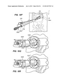 MINIMALLY INVASIVE, DIRECT DELIVERY METHODS FOR IMPLANTING OBESITY     TREATMENT DEVICES diagram and image