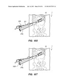 MINIMALLY INVASIVE, DIRECT DELIVERY METHODS FOR IMPLANTING OBESITY     TREATMENT DEVICES diagram and image