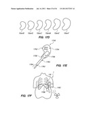 MINIMALLY INVASIVE, DIRECT DELIVERY METHODS FOR IMPLANTING OBESITY     TREATMENT DEVICES diagram and image