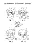 MINIMALLY INVASIVE, DIRECT DELIVERY METHODS FOR IMPLANTING OBESITY     TREATMENT DEVICES diagram and image