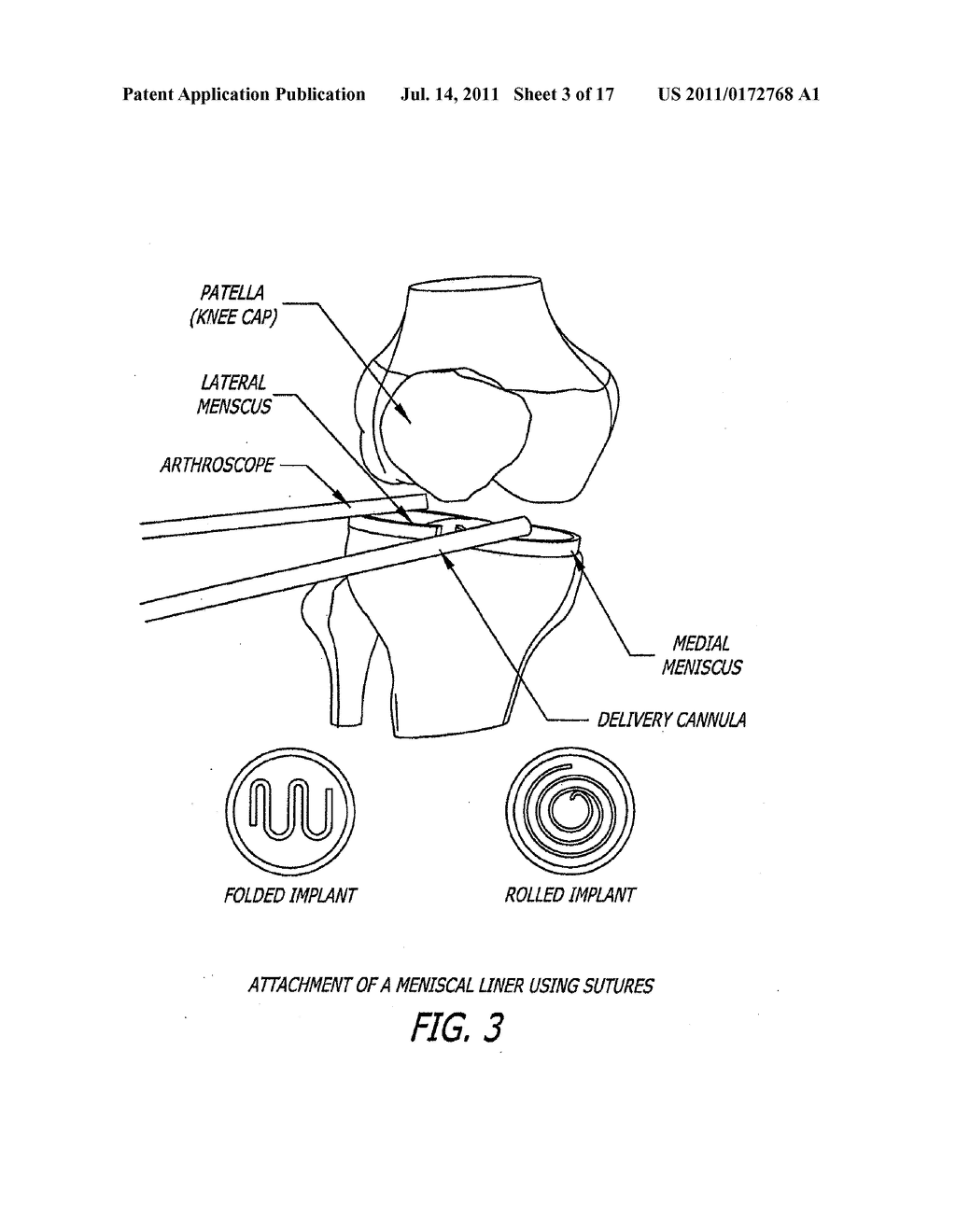 KNEE JOINT PROSTHESIS AND HYALURONATE COMPOSITIONS FOR TREATMENT OF     OSTEOARTHRITIS - diagram, schematic, and image 04