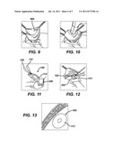 Implantable Repair Device diagram and image