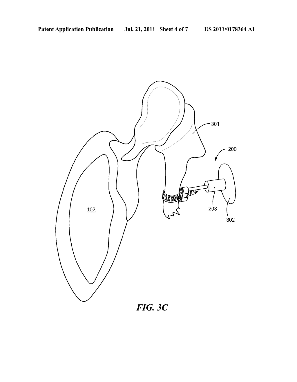 Incus Replacement Partial Ossicular Replacement Prosthesis - diagram, schematic, and image 05