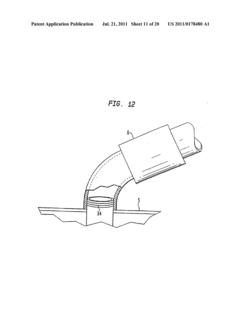 Shunt Apparatus For Treating Obesity By Extracting Food - diagram, schematic, and image 12