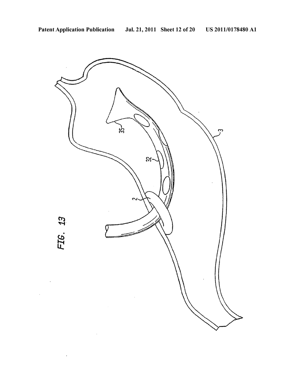 Shunt Apparatus For Treating Obesity By Extracting Food - diagram, schematic, and image 13