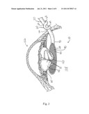 Opthalmic Lens Capsule Support diagram and image