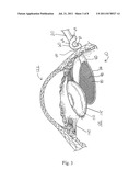 Opthalmic Lens Capsule Support diagram and image