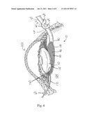 Opthalmic Lens Capsule Support diagram and image