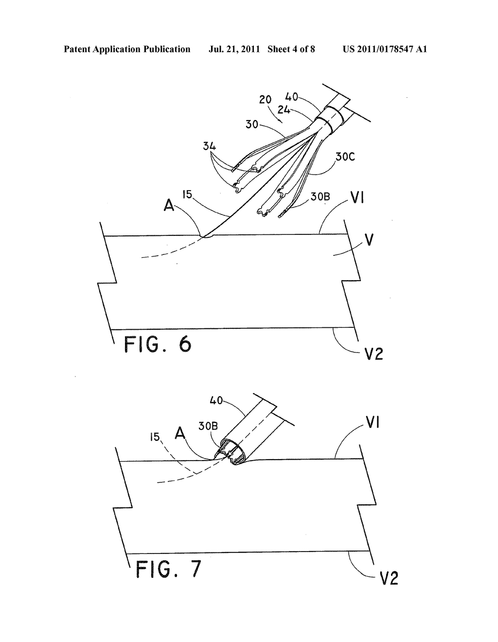 DEVICE AND METHOD FOR CLOSURE OF VESSEL ACCESS SITE - diagram, schematic, and image 05