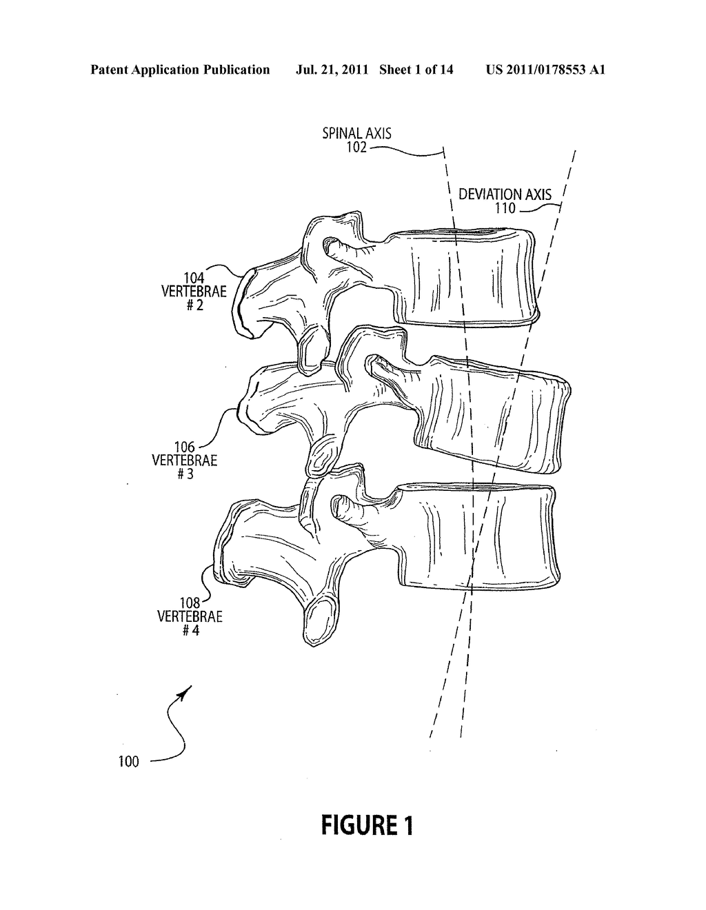 METHOD AND APPARATUS FOR LATERAL REDUCTION AND FUSION OF THE SPINE - diagram, schematic, and image 02