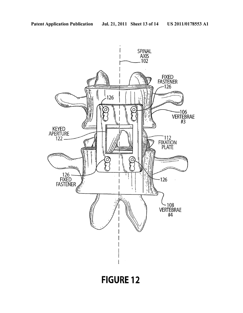 METHOD AND APPARATUS FOR LATERAL REDUCTION AND FUSION OF THE SPINE - diagram, schematic, and image 14