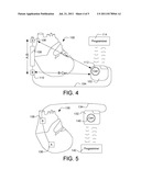 Dynamically Filtered Beat Detection in an Implantable Cardiac Device diagram and image