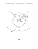 VAGINAL REMODELING DEVICE AND METHODS diagram and image