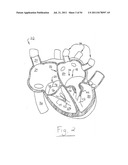 APPARATUS AND METHOD FOR REPLACING A DISEASED CARDIAC VALVE diagram and image