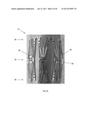 APPARATUS AND METHOD FOR REPLACING A DISEASED CARDIAC VALVE diagram and image