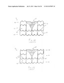 APPARATUS AND METHOD FOR REPLACING A DISEASED CARDIAC VALVE diagram and image