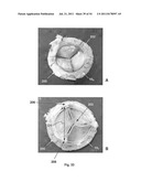 APPARATUS AND METHOD FOR REPLACING A DISEASED CARDIAC VALVE diagram and image