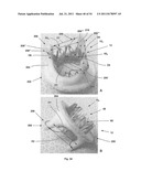 APPARATUS AND METHOD FOR REPLACING A DISEASED CARDIAC VALVE diagram and image