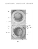 APPARATUS AND METHOD FOR REPLACING A DISEASED CARDIAC VALVE diagram and image