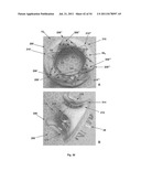 APPARATUS AND METHOD FOR REPLACING A DISEASED CARDIAC VALVE diagram and image