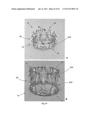 APPARATUS AND METHOD FOR REPLACING A DISEASED CARDIAC VALVE diagram and image