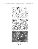 METHOD TO IDENTIFY PATIENTS AT RISK FOR LUNG TRANSPLANT REJECTION diagram and image