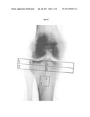 BONE MINERAL DENSITY RATIOS AS A PREDICTOR OF OSTEOARTHRITIS diagram and image