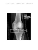 BONE MINERAL DENSITY RATIOS AS A PREDICTOR OF OSTEOARTHRITIS diagram and image