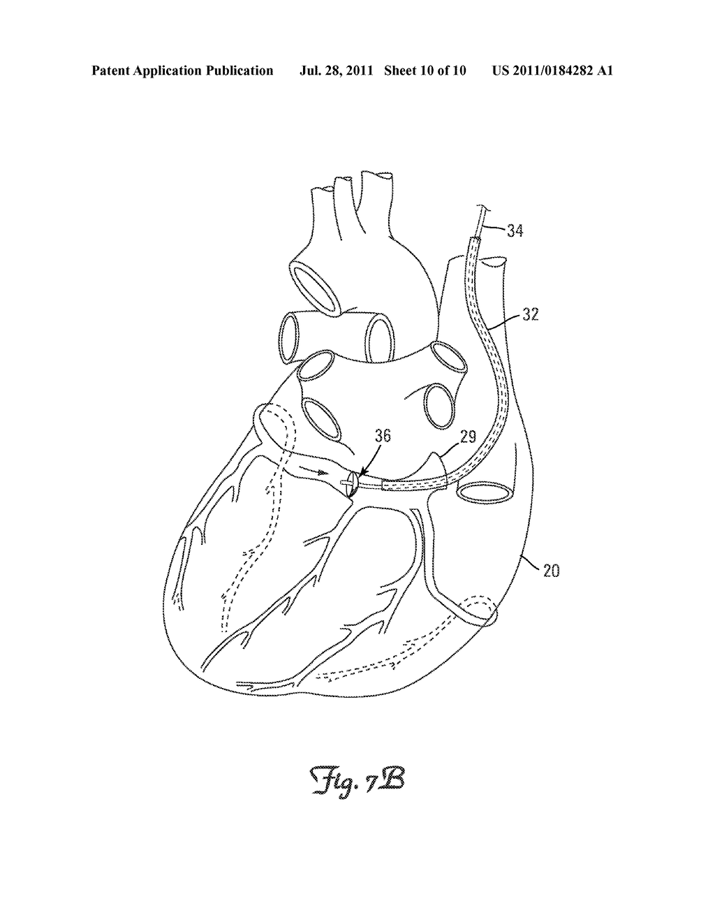 SELF-DEPLOYING VASCULAR OCCLUSION DEVICE - diagram, schematic, and image 11