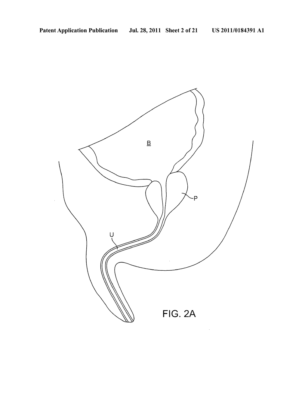 MULTI FLUID TISSUE RESECTION METHODS AND DEVICES - diagram, schematic, and image 03