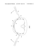 SURGICAL TOOL FOR PECTUS BAR EXTRACTION diagram and image