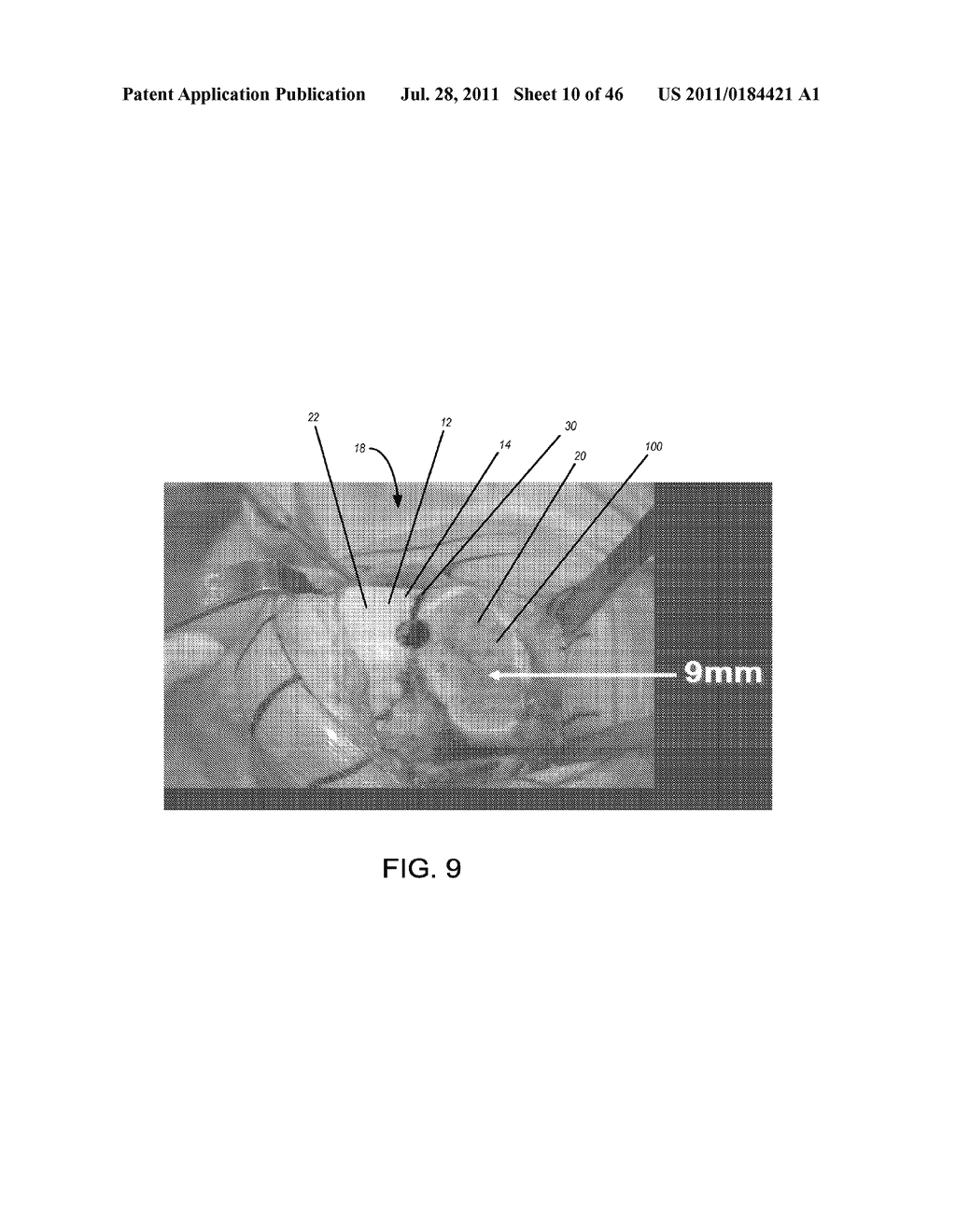 Instrumentation for Implants with Transition Surfaces and Related     Processes - diagram, schematic, and image 11