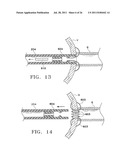 Apparatus and Methods for Anastomosis diagram and image