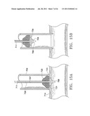 Apparatus and Methods for Anastomosis diagram and image