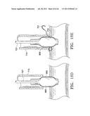 Apparatus and Methods for Anastomosis diagram and image