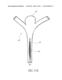 VASCULAR REMODELING DEVICE diagram and image