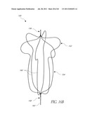 VASCULAR REMODELING DEVICE diagram and image