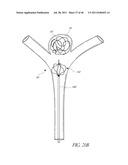 VASCULAR REMODELING DEVICE diagram and image