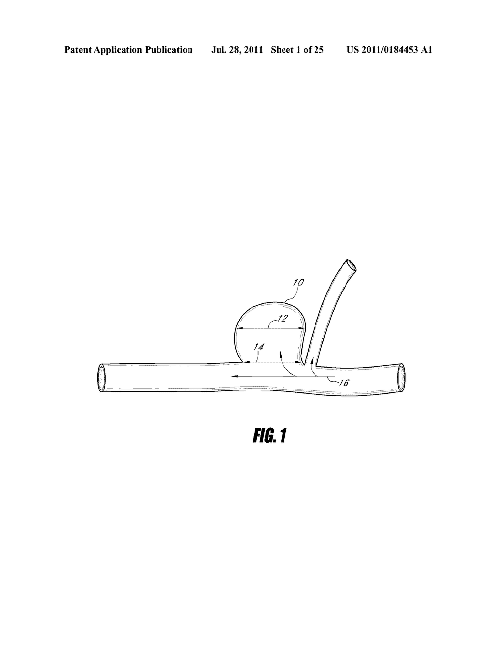 VASCULAR REMODELING DEVICE - diagram, schematic, and image 02