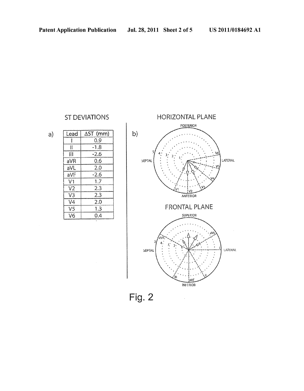  SYSTEM AND A METHOD FOR SPATIAL ESTIMATION AND VISUALIZATION OF     MULTI-LEAD ELECTROCARDIOGRAPHIC ST DEVIATIONS - diagram, schematic, and image 03