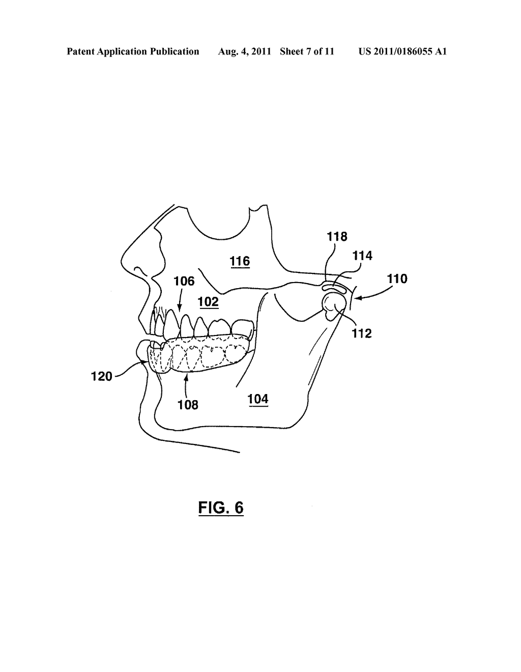 METHODS OF PREPARING CUSTOMIZED, NEUROMUSCULAR MOUTHPIECES FOR ENHANCING     ATHLETIC PERFORMANCE - diagram, schematic, and image 08