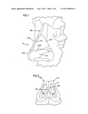 NASAL VALVE TREATMENT METHOD & APPARATUS diagram and image