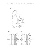 NASAL VALVE TREATMENT METHOD & APPARATUS diagram and image