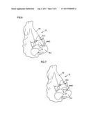 NASAL VALVE TREATMENT METHOD & APPARATUS diagram and image