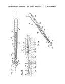 NASAL VALVE TREATMENT METHOD & APPARATUS diagram and image