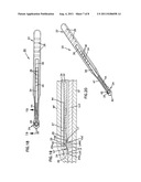 NASAL VALVE TREATMENT METHOD & APPARATUS diagram and image