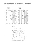 NASAL VALVE TREATMENT METHOD & APPARATUS diagram and image