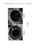 DRUG-ELUTING STENTS FOR ADENOSINE RECEPTOR MODULATION diagram and image