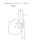 Surgical method and medical device diagram and image