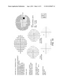 GLAUCOMA COMBINATORIAL ANALYSIS diagram and image